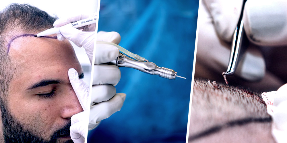 FUE HAIR TRANSPLANT 05 FUE HAIR TRANSPLANT