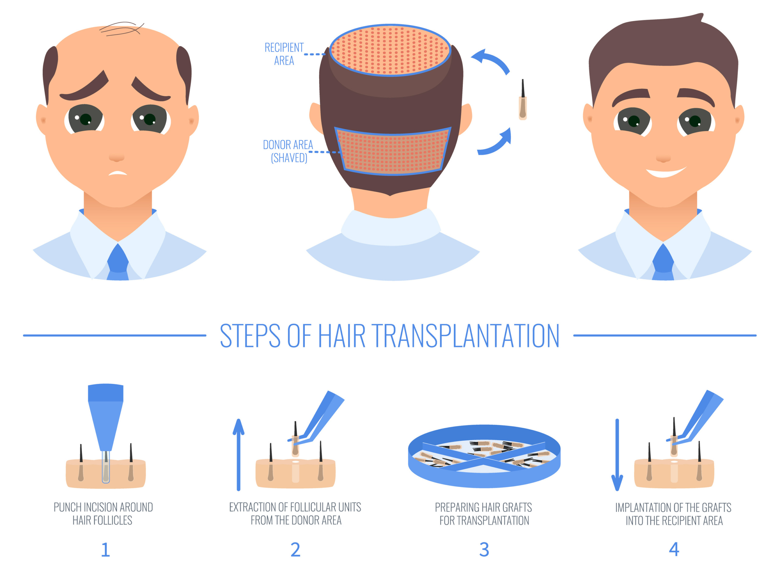 How do FUE Hair Transplant works? How do FUE Hair Transplant works?