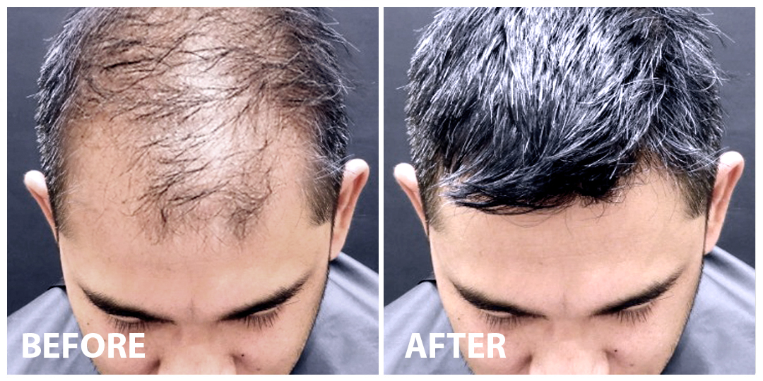 FUE Hair Transplant Before After 01 FUE Hair Transplant Before After