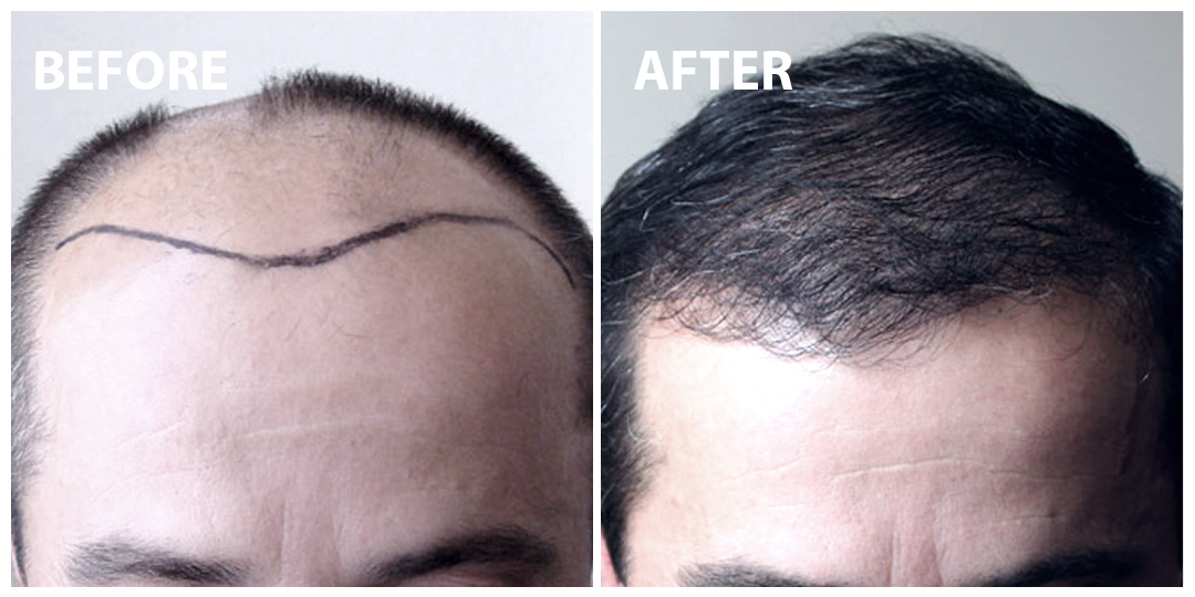 FUE Hair Transplant Before After 02 FUE Hair Transplant Before After