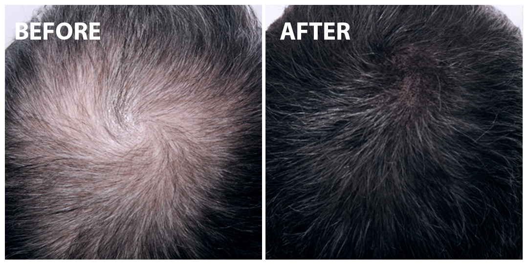 FUE Hair Transplant Before After 03 FUE Hair Transplant Before After