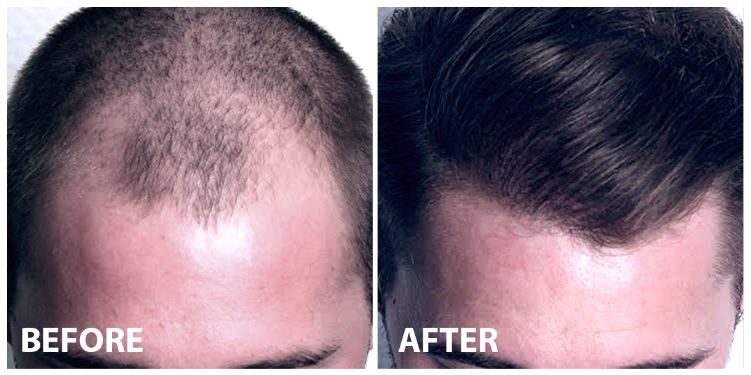 FUE Hair Transplant Before After FUE Hair Transplant Before After