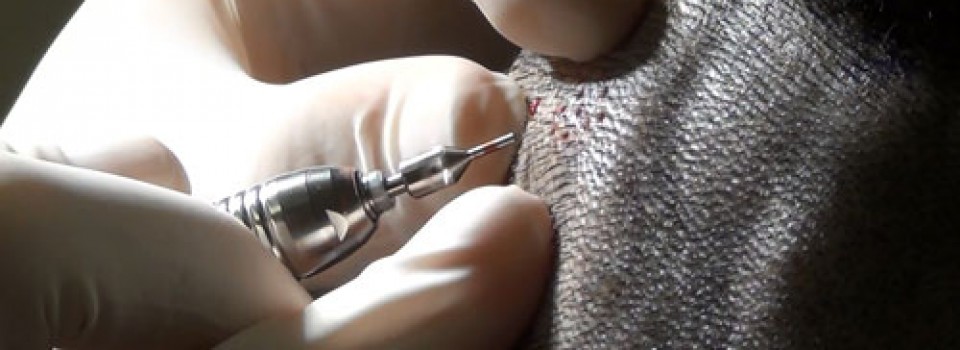 FUE HAIR TRANSPLANT FUE HAIR TRANSPLANT