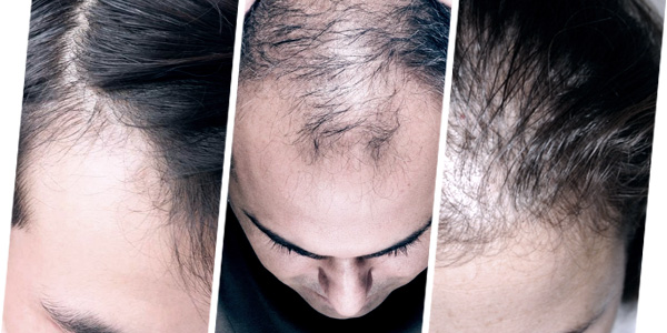 SIAPA CALON YANG SESUAI UNTUK RAWATAN TANAM RAMBUT?