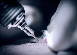 Rawatan tanam rambut memerlukan 2 minggu untuk pulih