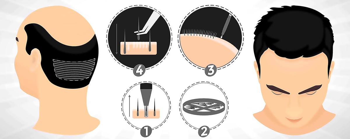 CARA RAWATAN TANAM RAMBUT 